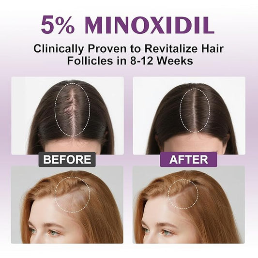 5% Minoxidil Spray for Women-4 PCS ,monoxide for men hair Infused with Biotin, hers hair regrowth treatment, Supports Thicker and Fuller Hair & Beard (13oz, 7 Month Supply)