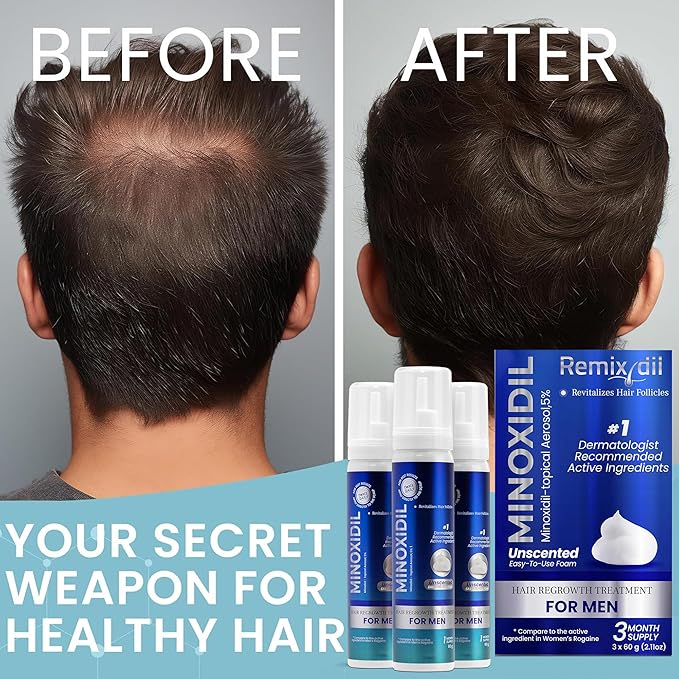 Remixidil Men’s 5% Minoxidil Foam | Hair Regrowth Treatment for Men | Clinically Proven Formula for Hair Loss and Hair Growth | No Scalp Irritation | 3-Month Supply