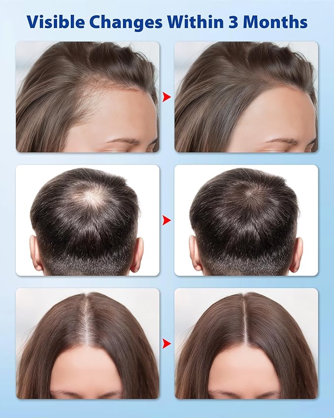 Hair Growth Serum Roll On 30ml – 3% Rosemary, 3% Redensyl,2% Anagain, Niacinamide & Tocopherol | Reduces Hair Loss at the Root for Men & Women | No-Rinse, Non-Greasy, Fast-Absorbing