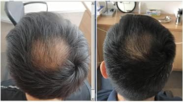 Pharma Hermetic Hair Growth Serum SP55, Professional 7 Week Hair Regrowth Kit, Scalp Serum For Thinning Hair with Biotin, Caffeine and Peptide Complex for Women and Men, Hair Serum (5x5mL)