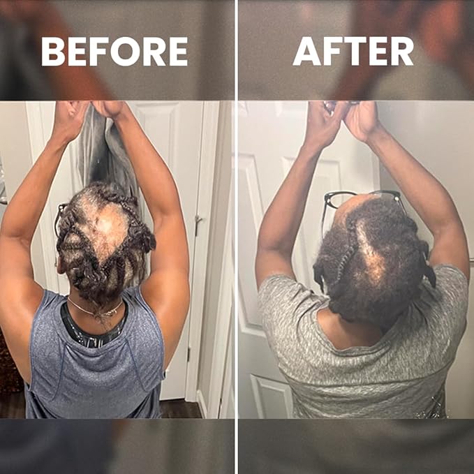 Rennora Hair Growth Serum with Organic Herbs and Natural Vitamins, Peppermint Oil, Stinging Nettle, and Rosemary Oil, No Chemicals, Formulated for Hair Regrowth (4 Pack - 120 Day Supply)