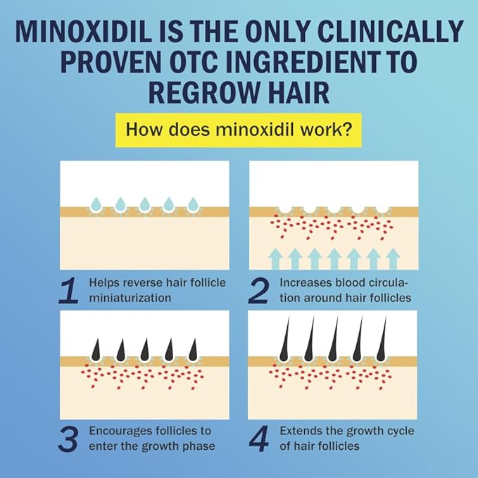 5% Minoxidil Foam for Hair Regrowth, Topical Hair Loss Treatment for Men to Regrow Fuller, Thicker Hair, Rosemary Minoxidil Topical Aerosol, 60ml / 2.11oz
