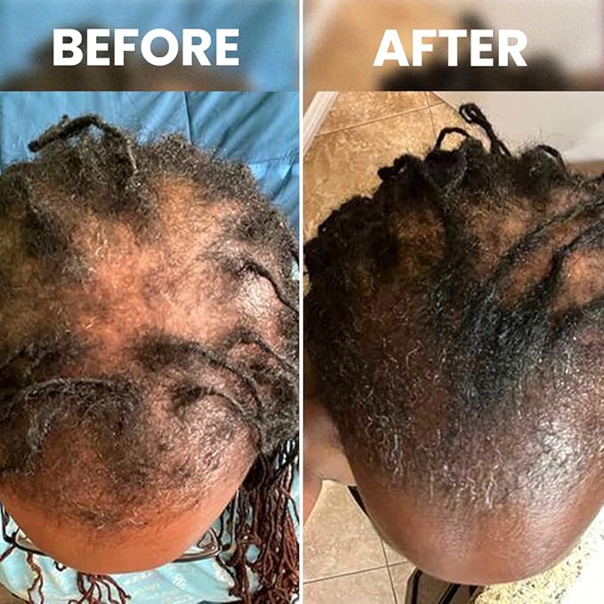 Rennora Hair Growth Serum with Organic Herbs and Natural Vitamins, Peppermint Oil, Stinging Nettle, and Rosemary Oil, No Chemicals, Formulated for Hair Regrowth (4 Pack - 120 Day Supply)