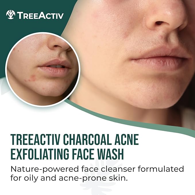 TreeActiv Acne Charcoal Face Wash, 3.4oz, Daily Face Wash with Sulfur and Honey, Charcoal Face Cleanser, Mens Face Wash for Acne, Deep Cleansing Charcoal Face Wash for Women and Men, 400+ Uses, 2-Pack