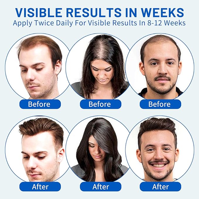 5% Minoxidil Hair Growth Foam for Men & Women – 2 Pack (60ml Each) | Extra Strength Hair Regrowth Treatment with Biotin | Supports Thicker, Fuller-Looking Hair