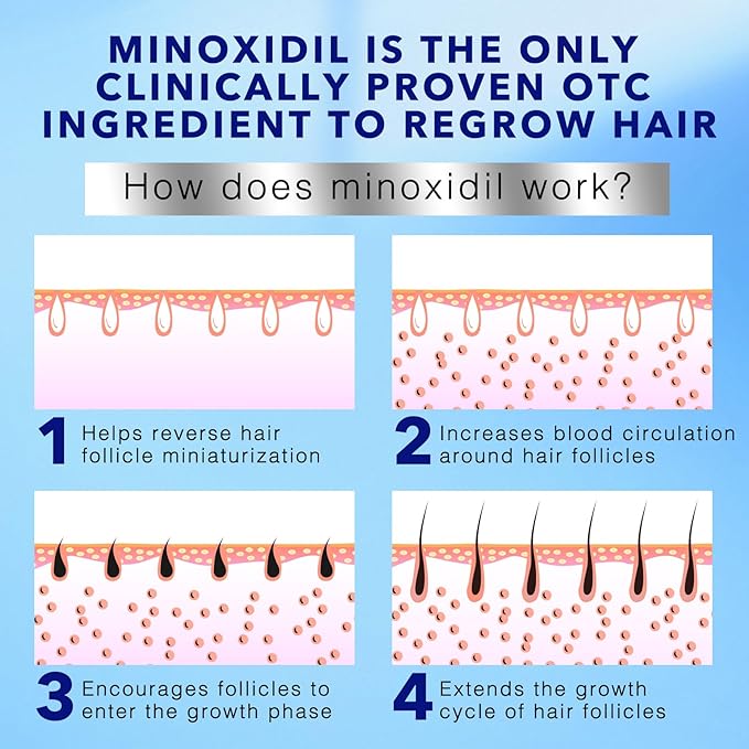 5% Minoxidil Foam for Hair Regrowth, Topical Hair Loss Treatment for Men to Regrow Fuller, Thicker Hair, Rosemary Minoxidil Topical Aerosol, 60ml / 2.11oz