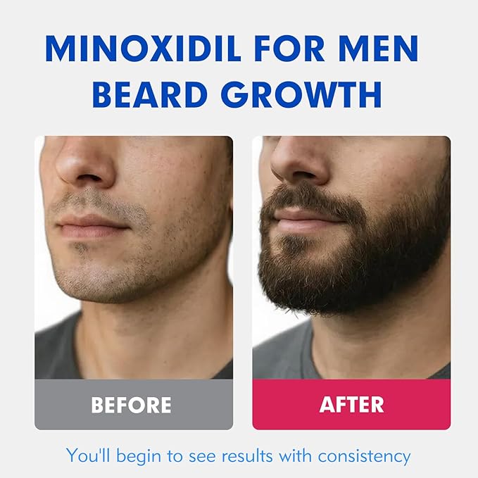 5% Minoxidil for Men, Extra Strength Hair Growth Serum, Beard Growth Oil, Fast Absorbing Dropper, Non Greasy, Low Residue Formula, 2-Pack for 2 Months, Hair Regrowth Treatment for Thinning Hair