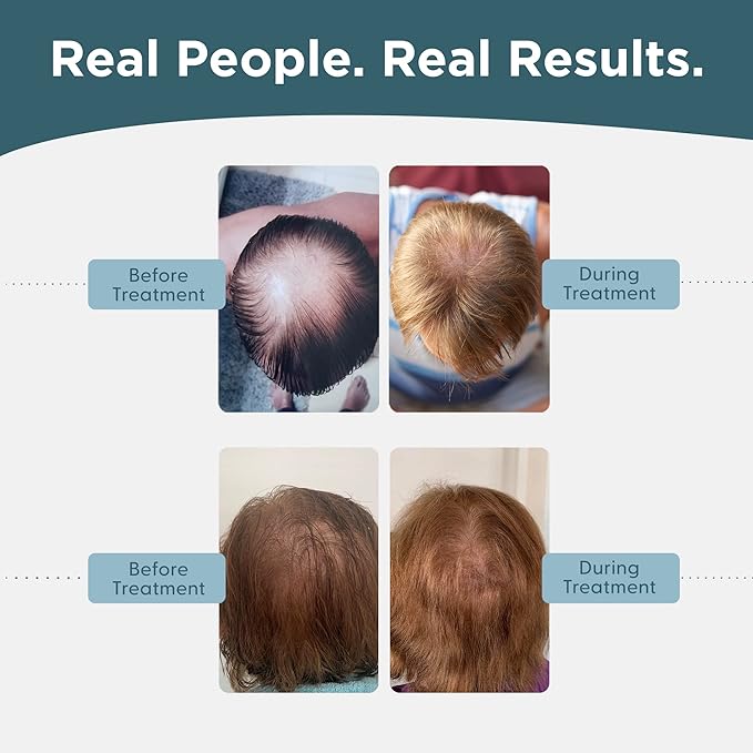 Shapiro MD Hair Growth Experts Minoxidil 5% Topical Solution for Men's Hair Growth, Serum Promotes Hair Regrowth by Reactivating Hair Follicles - 1 Month