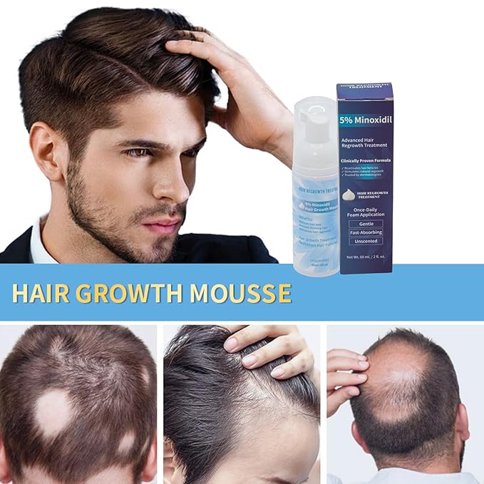 Minoxidil 5% Foam for Hair Growth, Topical Hair Loss Treatment for Men and Women, 3 Pack (2 oz Bottle) (1PC)