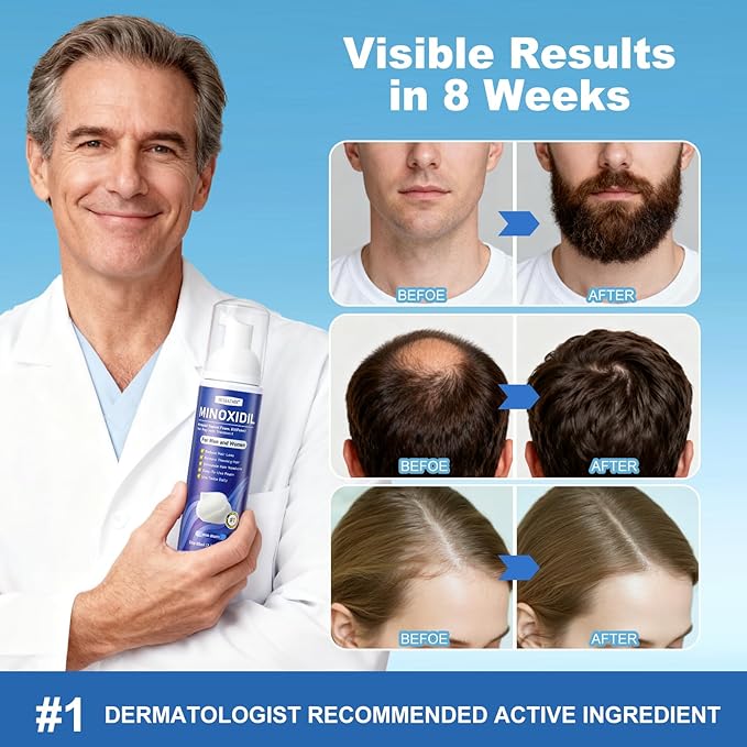 6 Packs 80ml 5% Minoxidil Foam for Men & Women - 6 x 2.71oz 8-Month Supply, with Biotin & Castor Oil, Hair Growth Treatment for Thicker, Fuller Hair & Beard Regrowth