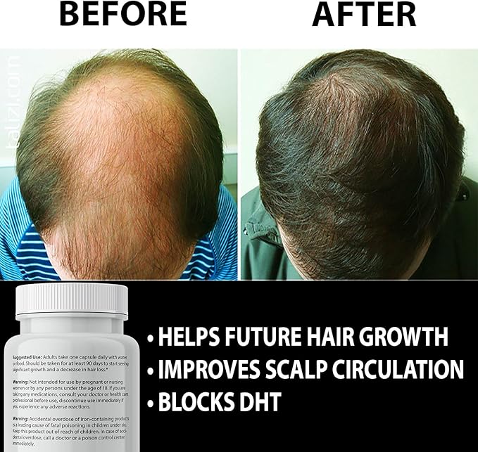 Finanutride Natural DHT Blocker & Hair Growth Capsules - Prevent Hair Loss, Stimulate Follicles, Proprietary Regrowth Treatment