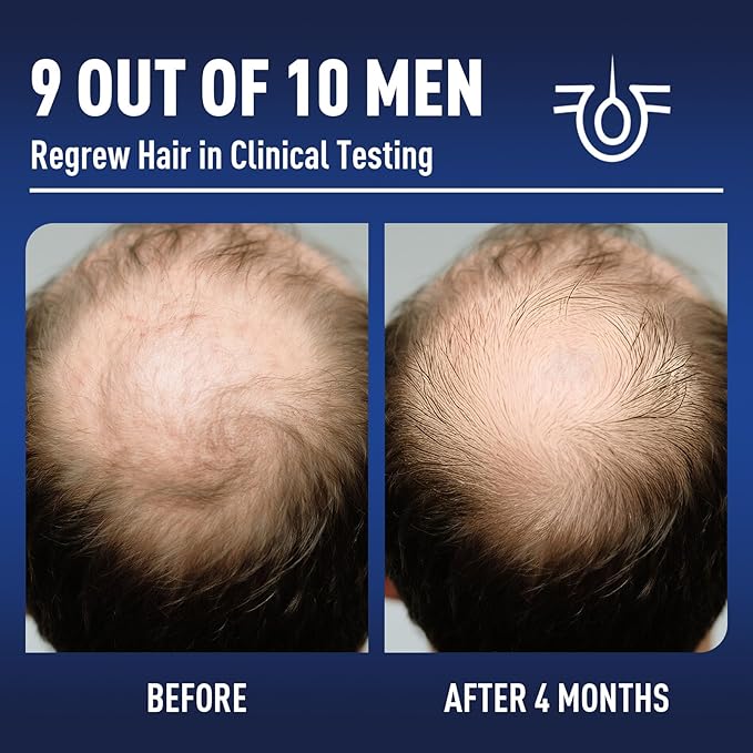 5% Minoxidil Hair Growth With Biotin: Minoxidil for Men and Women - Hair Growth Supports Thicker and Fuller Beard & Hair(2 Pack 4Oz For 4 Month Supply)