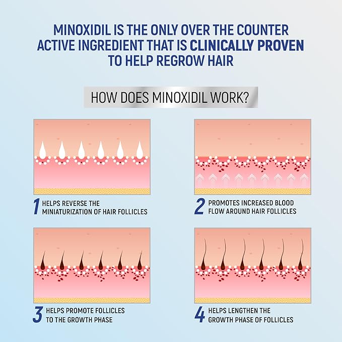 Minoxidil topical aerosol foam, 5%, hair regrowth 2 months treatment for men, 2.11 oz (2 Pack)