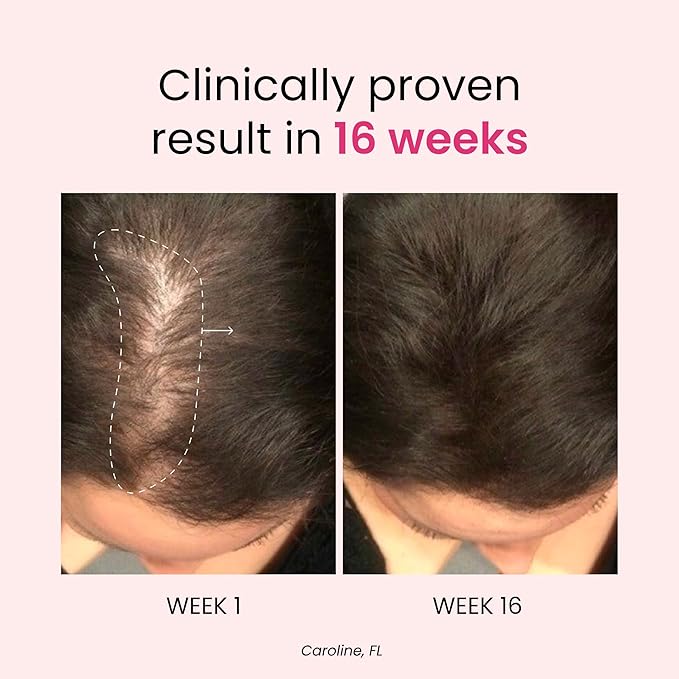 Trybello Anti-Stress & Hair Growth Gummies for Women | Sugar-Free, Vegan Hair Supplements | Gluten-Free, Soy-Free, Dairy-Free Gummy Vitamins for Thicker, Healthier Hair | 30 Servings