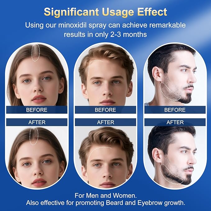 5% Minoxidil Spray for Men & Women - Hair Growth Serum & Hair Regrowth Treatment | Extra Strength with Biotin | 12-Month Supply 8-Pack (28 fl oz) | Clinically Proven for Hair Loss & beard growth