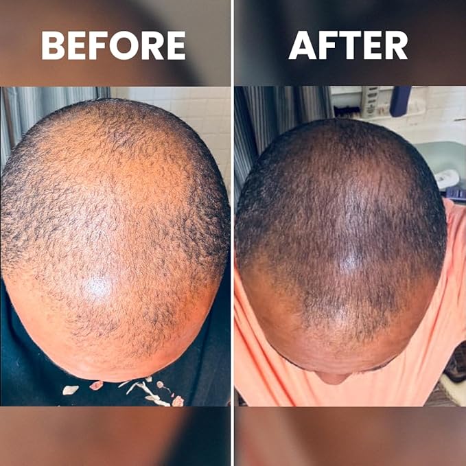 Rennora Hair Growth Serum with Organic Herbs and Natural Vitamins, Peppermint Oil, Stinging Nettle, and Rosemary Oil, No Chemicals, Formulated for Hair Regrowth (4 Pack - 120 Day Supply)