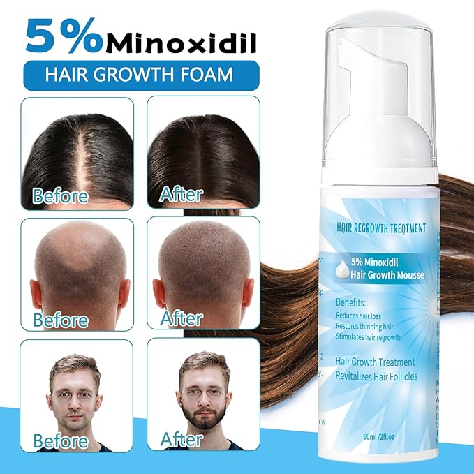 5% Minoxidil Foam for Men, Minoxidil for Women Hair Growth, Infused with Biotin, Hair Growth Treatment, Foam Hair Regrowth Treatment for Hair Thinning Receding Hairline,(2 oz Bottle), 3-Pack