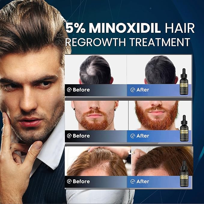 5% Minoxidil Hair Growth for Men and Women: Biotin Hair Growth Serum for Beard & Hair Loss, Thinning, and Faster Regrowth Treatment - 60ML