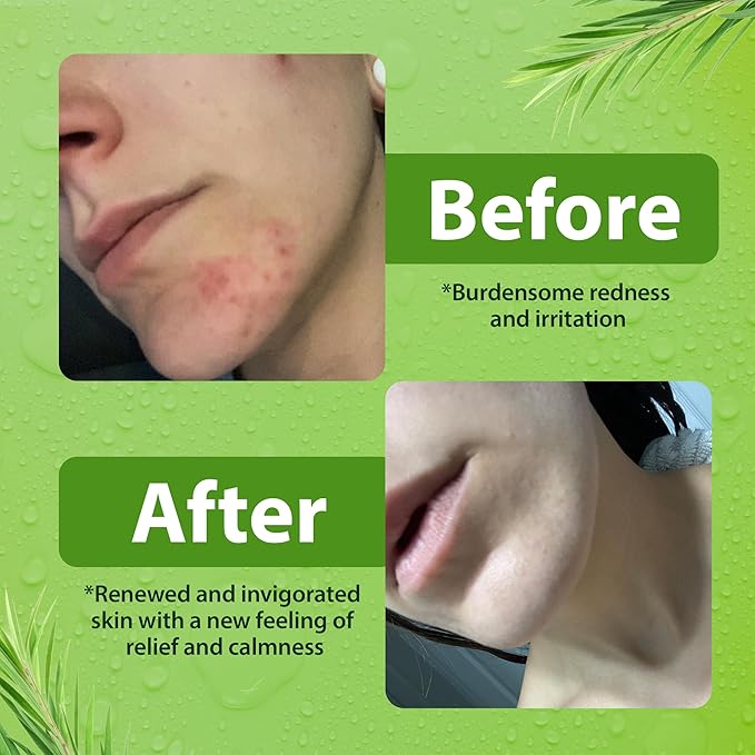 Antibacterial Body Wash - Antibacterial Soap And Tea Tree Body Wash For Jock Itch, Athletes Foot, Eczema And Back Acne - Anti Bacterial Body Soap For Men And Women Safe For All Skin Types - 2 Pack