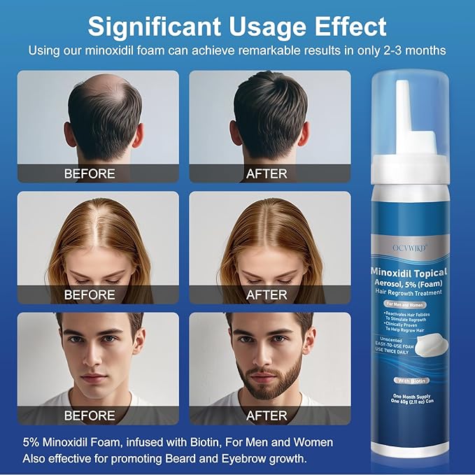 5% Minoxidil Foam, Biotin-Infused, Unisex Adult, Hair Growth Treatment, Unscented, Foam, 12.66 Ounce, 6-Month Supply, Supports Thicker and Fuller Hair & Beard