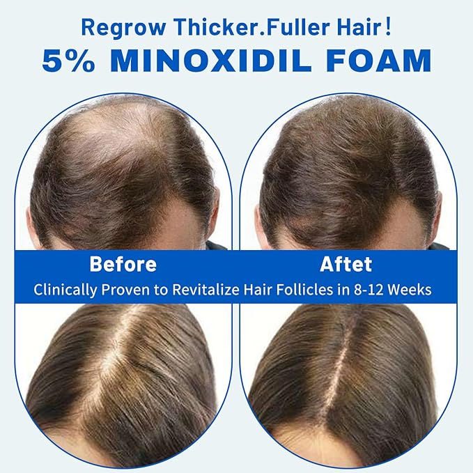 5% Minoxidil Hair Growth Foam for Men & Women – 2 Pack (60ml Each) | Extra Strength Hair Regrowth Treatment with Biotin | Supports Thicker, Fuller-Looking Hair