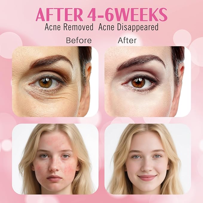 FSA Pro LED Light Therapy Facial Mask- Target Acne Removal, Wrinkles & Redness with Salon-Level Light Therapy at Home,Restore Skin