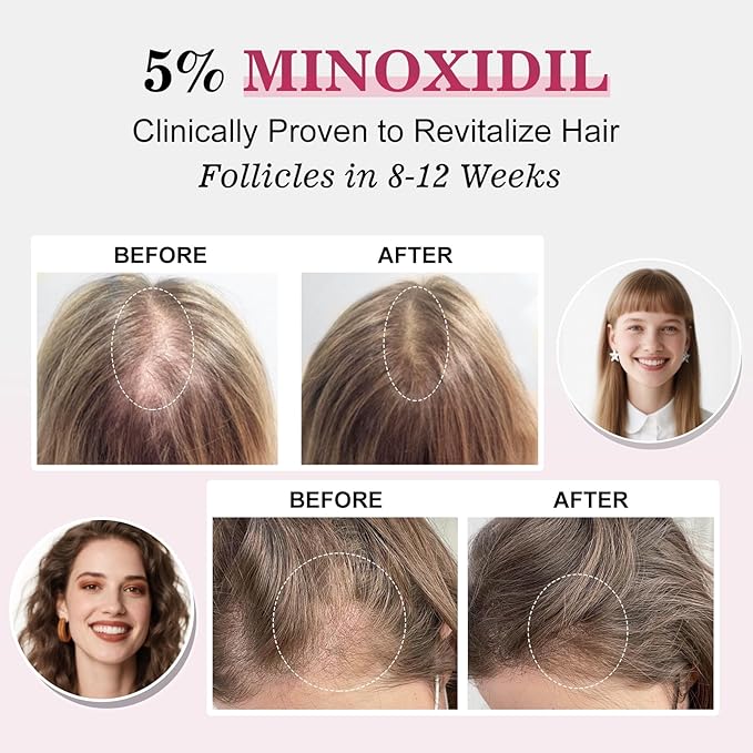 5% Minoxidil for Women Hair Regrowth Spray, hers hair regrowth treatment Infused with Biotin, Extra Strength Treatment to Combat Hair Loss and Thinning, 6 Bottles（100 Ml)