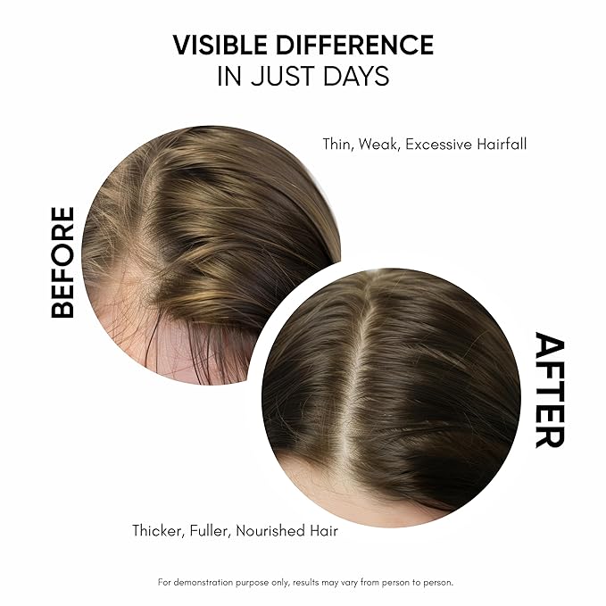 Hair Growth Serum For Promoting Hair Growth & Controlling Hair Fall With 3% Redensyl, 5% Capixyl, 4% Anagain, 3% Procapil & Rosemary & Biotin, For Both Men & Women, 50 ml (Pack of 1) White