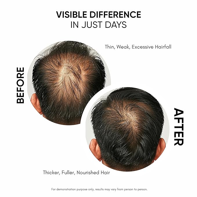 Hair Growth Serum For Density, Hair fall Control with 3% Redensyl, 5% Capixyl, 4% Anagain, 3% Procapil & 3% Baicapil, Rosemary & Biotin For Both Men & Women, 1.01 fl.oz./30ML