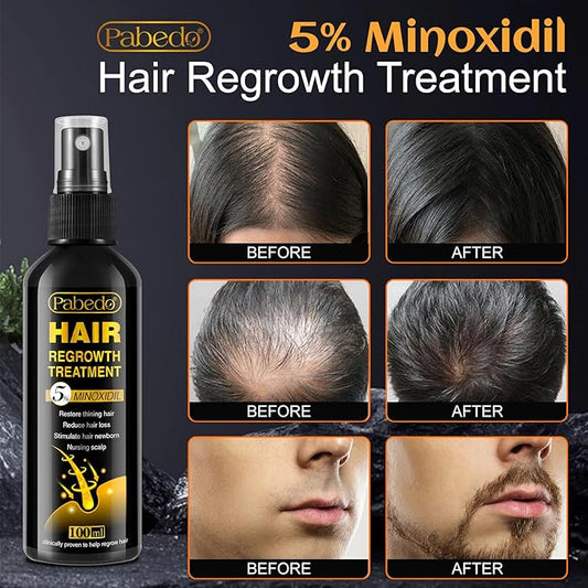 5% Minoxidil for Men and Women Hair Growth Serum - Castor Oil & Biotin Hair Growth Spray Hair Regrowth Treatment for Scalp Hair Loss Hair Thinning For Thicker Longer Fuller Healthier Hair 100Ml