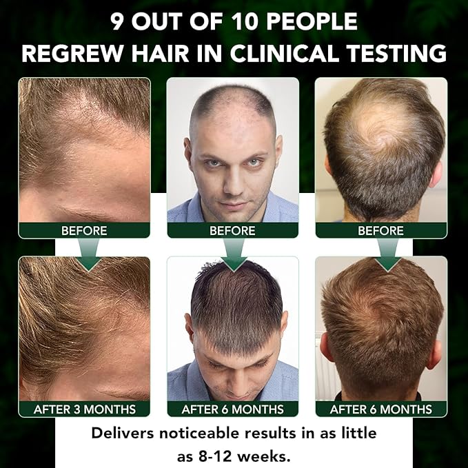 5% Minoxidil Hair Regrowth Treatment Kit for Men and Women, Minoxidil Spray Topical Solution with Scalp Massager for Hair Loss | Thinning | Hair Regrowth, Men Beard Growth Spray Kit