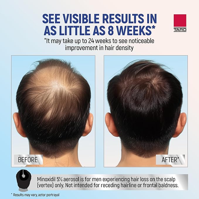 Minoxidil for Men, 2.11 Oz (1 Month Supply) Clinically Proven to Regrow Hair, Topical Aerosol Foam 5%, Hair Thinning Treatment