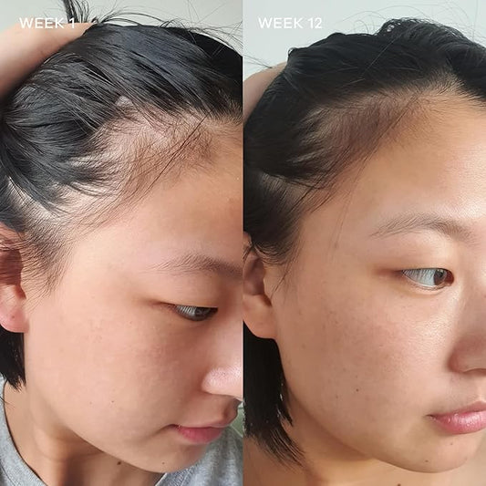 Vida Glow Hairology Hair Growth & Regrowth Capsules – Supports Thicker, Stronger Hair, Reduces Thinning & Loss with Biotin, 30 Vegan Capsules for Healthy Hair in Women