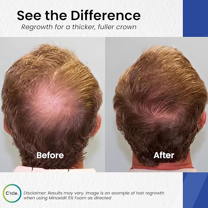 Minoxidil for Men Foam 5% - Unscented 6 Month Supply - Helps Restore Vertex Hair Loss & Thinning - 5% Minoxidil Foam For Men - Extra Strength Supports Hair Regrowth