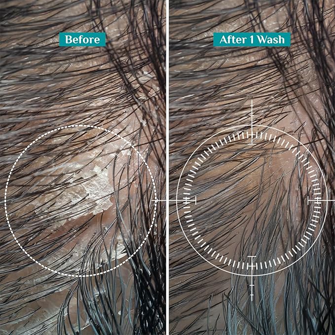 Pilgrim Anti-Dandruff Shampoo with Australian Tea Tree & Salicylic Acid | Non-Drying Itchy Scalp Treatment | Reduces Visible Flakes | Suitable for All Hair Types | 6.76 Fl Oz (200ml)