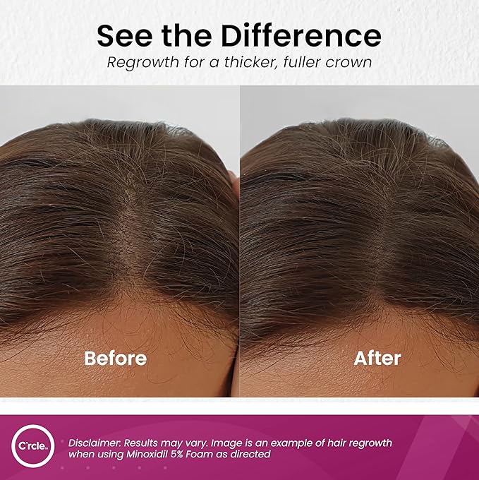 Minoxidil for Women 5% Foam - Helps Restore Top of Scalp Hair Loss and Support Hair Growth for Women, Regrowth with Unscented Topical Treatment for Thinning Hair (5% Foam 4-Month Supply)