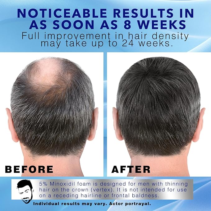 5% Minoxidil Foam for Hair Regrowth, Topical Hair Loss Treatment for Men to Regrow Fuller, Thicker Hair, Rosemary Minoxidil Topical Aerosol, 2-Month Supply, 2 x 2.11 oz