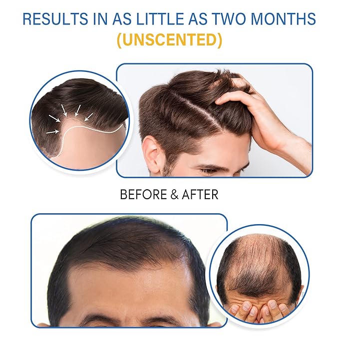 5% Minoxidil Foam for Men and Women Hair Growth, Minoxidil for Men and Women Foam, Lightweight Fast-Absorbing Non-Greasy Hair Regrowth Treatment for Thinning Hair and Balding